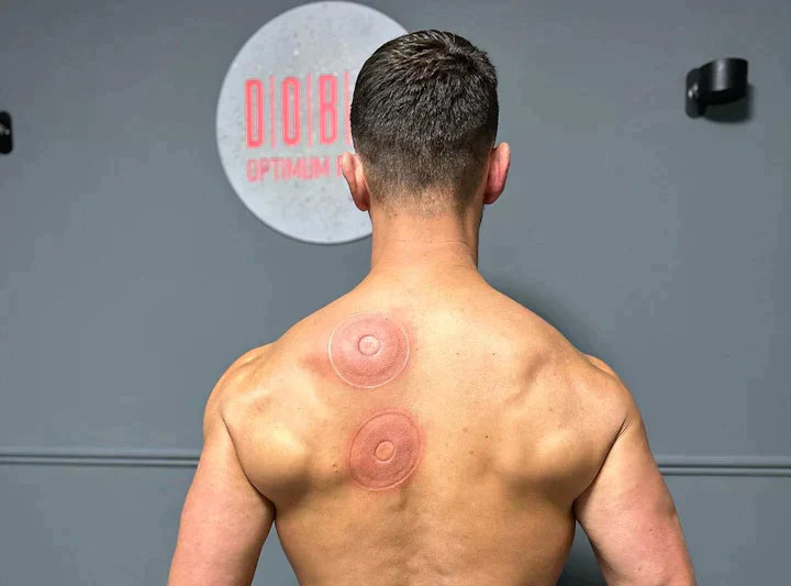 Smart Cupping Device